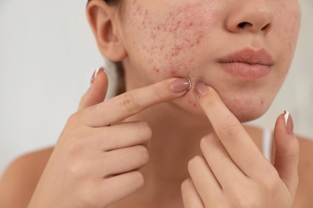Dermatology acne skin