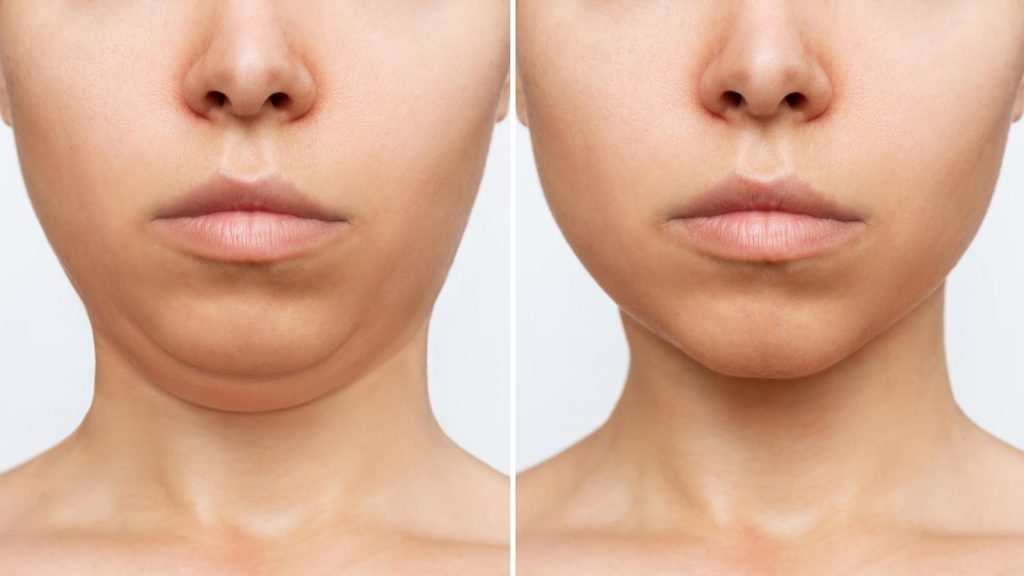 Cosmetic plastic surgery - liposuction - before and after transformation